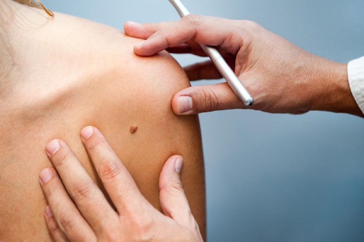 Ituzaingó cáncer de piel